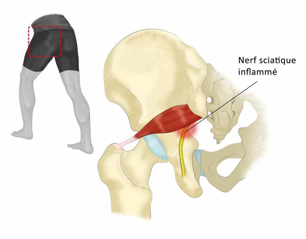 La fausse sciatique, ou le syndrome du piriforme - Vélo Mag